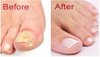 Get Rid of Unsightly Toenail Fungus